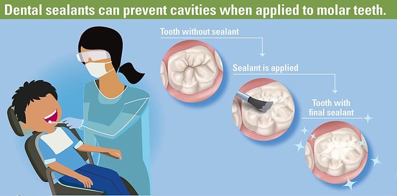 DENTAL SEALANTS 101